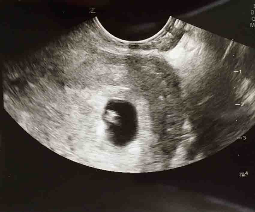 زرافه جادویی - سونوگرافی در هفته ششم بارداری