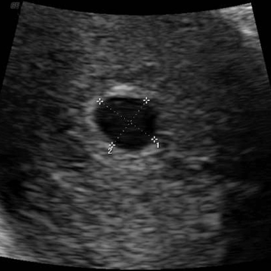 زرافه جادویی - سونوگرافی در هفته چهارم بارداری